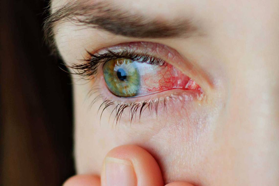 dry eye