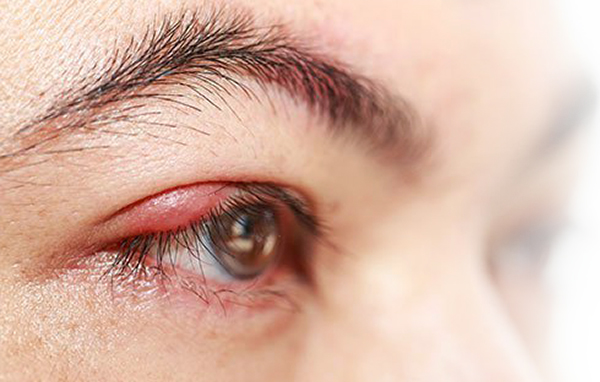 shalazion