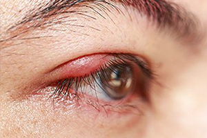 shalazion