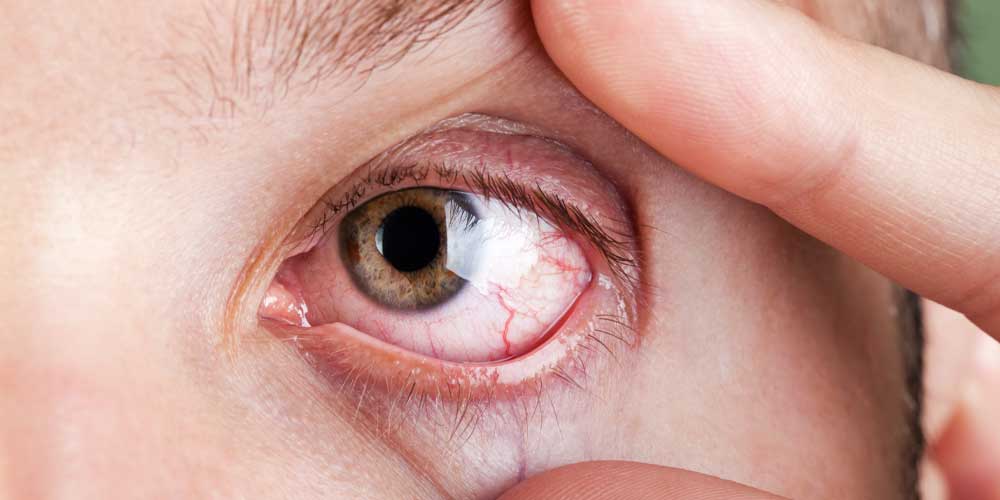 خشکی چشم و نشانه های آن