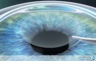 مقایسه عمل فیکوکاتاراکت و فمتوکاتاراکت
