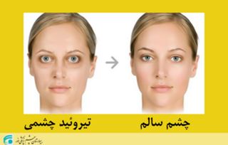 بیماری تیروئید چشمی و علائم آن 