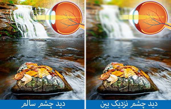 نزدیک بینی (Myopia)