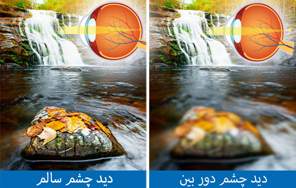 دوربینی (Hyperopia)