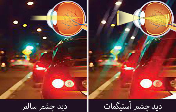 آستیگماتیسم (Astigmatism)