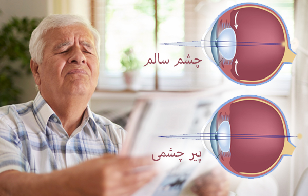 پیرچشمی (Presbyopia)