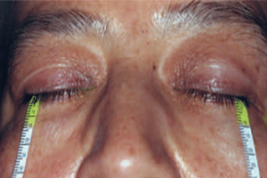 بررسی سیستم اشکی